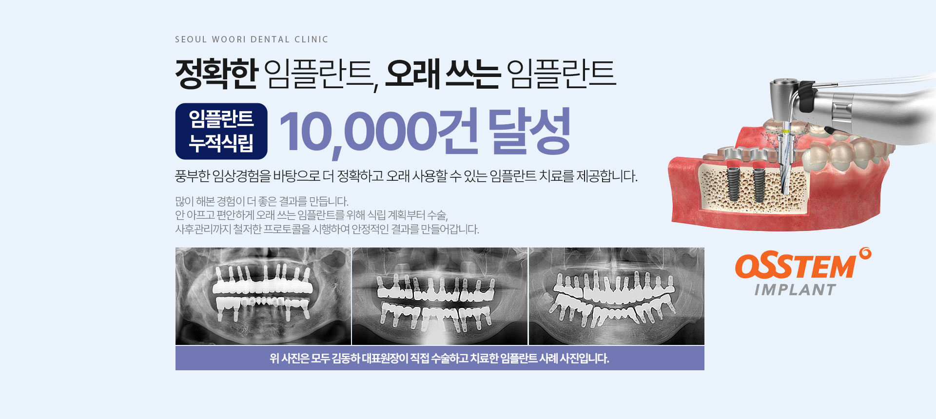 임플란트 누적식립 10,000건 달성, 정확하고 오래 쓰는 임플란트 치료